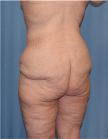 Body Lift Before Photo by Siamak Agha, MD PhD FACS; ,  - Case 43951