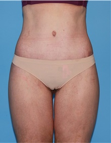 Body Lift After Photo by Siamak Agha, MD PhD FACS; ,  - Case 43953