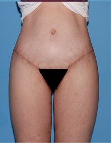 Body Lift After Photo by Siamak Agha, MD PhD FACS; ,  - Case 43953