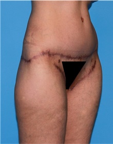 Body Lift Before Photo by Siamak Agha, MD PhD FACS; ,  - Case 43953