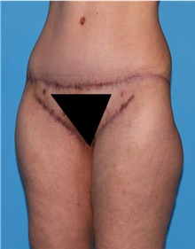 Body Lift Before Photo by Siamak Agha, MD PhD FACS; ,  - Case 43953
