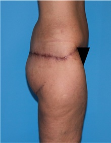 Body Lift Before Photo by Siamak Agha, MD PhD FACS; ,  - Case 43953