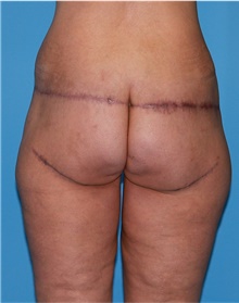 Body Lift Before Photo by Siamak Agha, MD PhD FACS; ,  - Case 43953