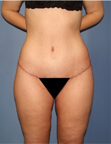 Body Lift After Photo by Siamak Agha, MD PhD FACS; ,  - Case 43977