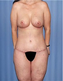 Body Contouring After Photo by Siamak Agha, MD PhD FACS; ,  - Case 43997
