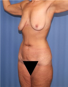 Body Contouring Before Photo by Siamak Agha, MD PhD FACS; ,  - Case 44000