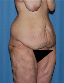 Body Contouring Before Photo by Siamak Agha, MD PhD FACS; ,  - Case 44038