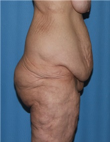 Body Contouring Before Photo by Siamak Agha, MD PhD FACS; ,  - Case 44038