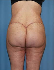 Body Contouring After Photo by Siamak Agha, MD PhD FACS; ,  - Case 44038