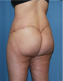 Body Contouring After Photo by Siamak Agha, MD PhD FACS; ,  - Case 44038