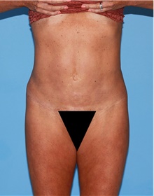 Body Contouring After Photo by Siamak Agha, MD PhD FACS; ,  - Case 44084