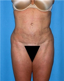 Body Contouring Before Photo by Siamak Agha, MD PhD FACS; ,  - Case 44084