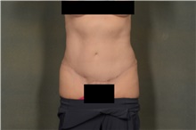 Tummy Tuck After Photo by Ellen Janetzke, MD; ,  - Case 44091