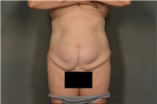 Tummy Tuck Before Photo by Ellen Janetzke, MD; ,  - Case 44091
