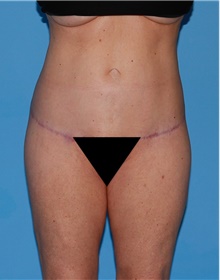 Body Contouring After Photo by Siamak Agha, MD PhD FACS; ,  - Case 44094