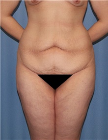 Body Contouring Before Photo by Siamak Agha, MD PhD FACS; ,  - Case 44103