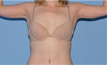 Arm Lift After Photo by Siamak Agha, MD PhD FACS; ,  - Case 44114