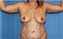 Arm Lift Before Photo by Siamak Agha, MD PhD FACS; ,  - Case 44115