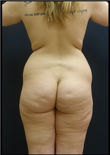 Buttock Lift with Augmentation Before Photo by Johnny Franco, MD; ,  - Case 44287
