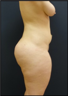 Buttock Lift with Augmentation After Photo by Johnny Franco, MD; ,  - Case 44287