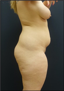 Buttock Lift with Augmentation Before Photo by Johnny Franco, MD; ,  - Case 44287