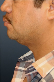 Liposuction Before Photo by Steve Laverson, MD, FACS; Rancho Santa Fe, CA - Case 44321