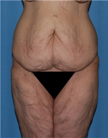 Thigh Lift Before Photo by Siamak Agha, MD PhD FACS; ,  - Case 44533