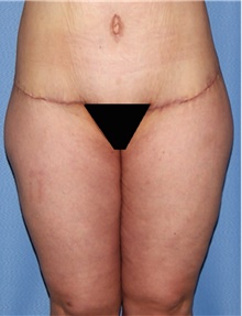 Thigh Lift After Photo by Siamak Agha, MD PhD FACS; ,  - Case 44535