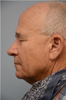 Brow Lift Before Photo by Carlos Rivera-Serrano, MD; ,  - Case 44590