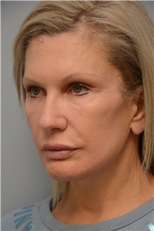 Facelift After Photo by Carlos Rivera-Serrano, MD; ,  - Case 44616