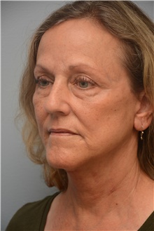Facelift After Photo by Carlos Rivera-Serrano, MD; ,  - Case 44730