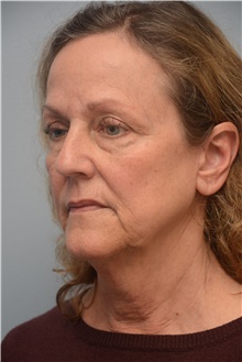 Facelift Before Photo by Carlos Rivera-Serrano, MD; ,  - Case 44730