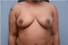 Breast Reconstruction After Photo by Carlos Rivera-Serrano, MD; ,  - Case 44732