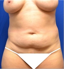 Tummy Tuck Before Photo by Stanley Okoro, MD; ,  - Case 44851