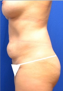 Tummy Tuck Before Photo by Stanley Okoro, MD; ,  - Case 44851