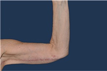 Arm Lift After Photo by Jerry Weiger Chang, MD, FACS; Flushing, NY - Case 44889