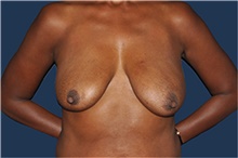 Breast Reconstruction Before Photo by Jerry Weiger Chang, MD, FACS; Flushing, NY - Case 44893
