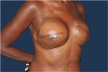 Breast Reconstruction After Photo by Jerry Weiger Chang, MD, FACS; Flushing, NY - Case 44893