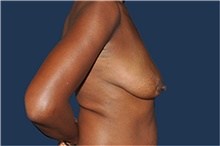 Breast Reconstruction Before Photo by Jerry Weiger Chang, MD, FACS; Flushing, NY - Case 44893