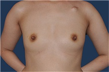 Breast Reconstruction Before Photo by Jerry Weiger Chang, MD, FACS; Flushing, NY - Case 44894