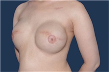 Breast Reconstruction After Photo by Jerry Weiger Chang, MD, FACS; Flushing, NY - Case 44894