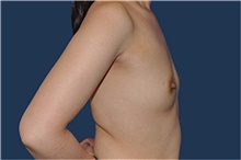 Breast Reconstruction Before Photo by Jerry Weiger Chang, MD, FACS; Flushing, NY - Case 44894