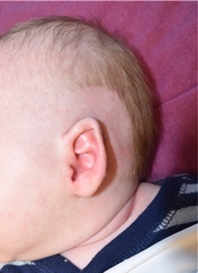Ear Surgery Before Photo by Rachel Ruotolo, MD; Garden City, NY - Case 44966