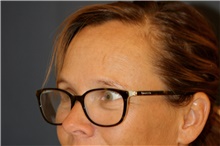 Brow Lift Before Photo by Steve Laverson, MD, FACS; Rancho Santa Fe, CA - Case 44984