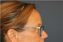 Brow Lift Before Photo by Steve Laverson, MD, FACS; Rancho Santa Fe, CA - Case 44984