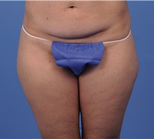 Tummy Tuck Before Photo by Katerina Gallus, MD, FACS; San Diego, CA - Case 45321
