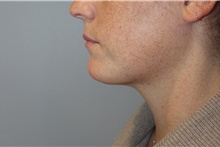 Liposuction After Photo by Ellen Mahony, MD; Westport, CT - Case 45417