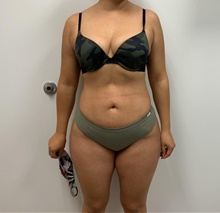 Buttock Lift with Augmentation After Photo by Johnny Franco, MD; ,  - Case 45442