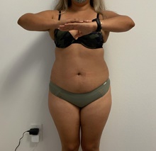 Buttock Lift with Augmentation Before Photo by Johnny Franco, MD; ,  - Case 45442