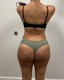 Buttock Lift with Augmentation After Photo by Johnny Franco, MD; ,  - Case 45442